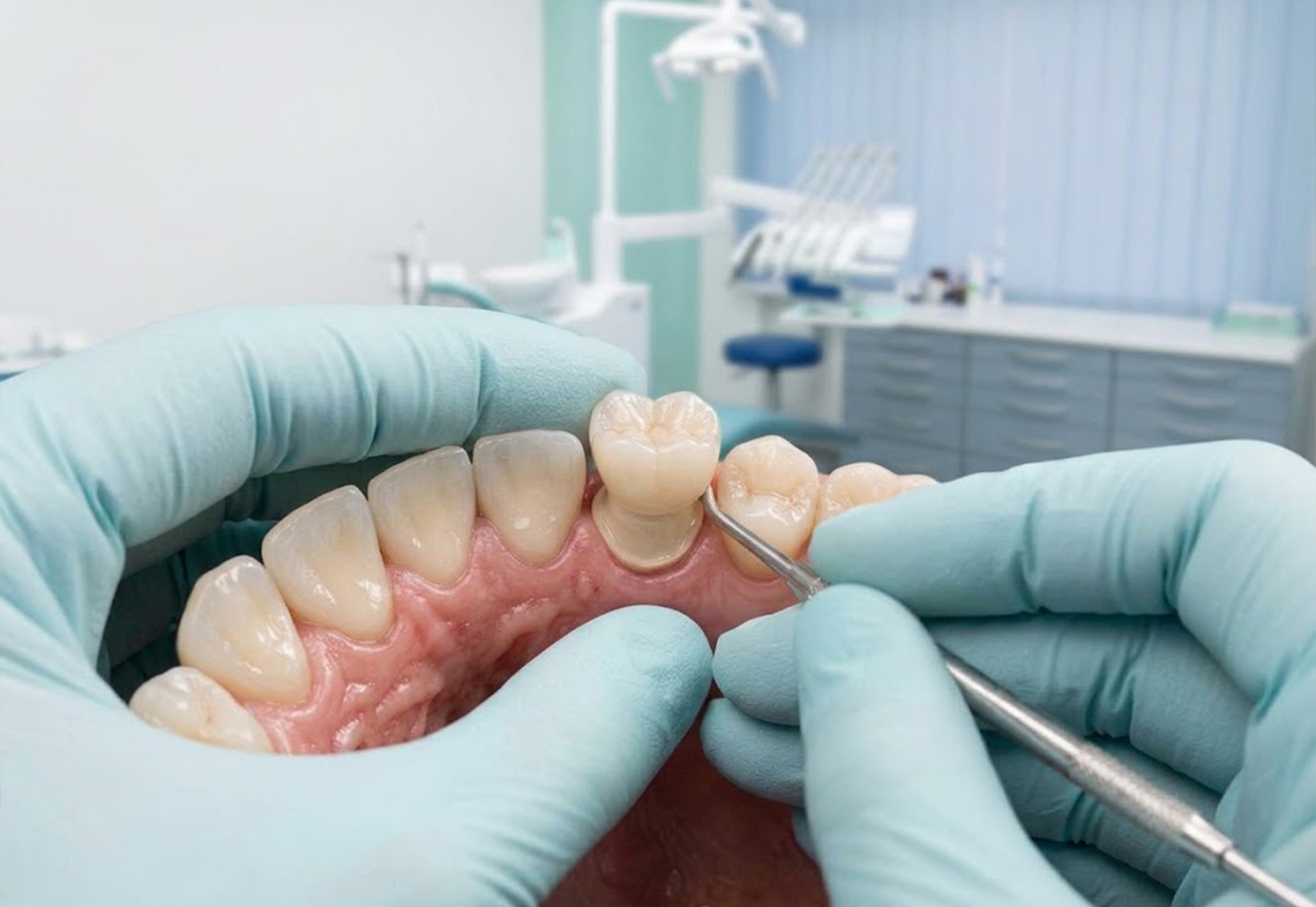 Dental crowns illustrative placeholder artwork